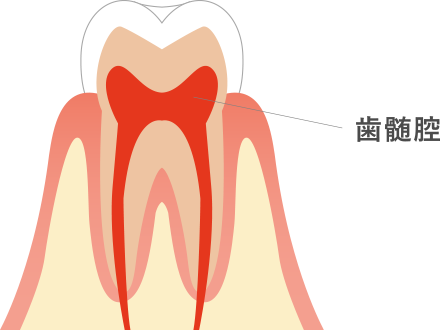 歯髄腔